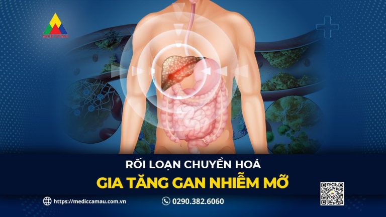RỐI LOẠN CHUYỂN HOÁ GIA TĂNG GAN NHIỄM MỠ