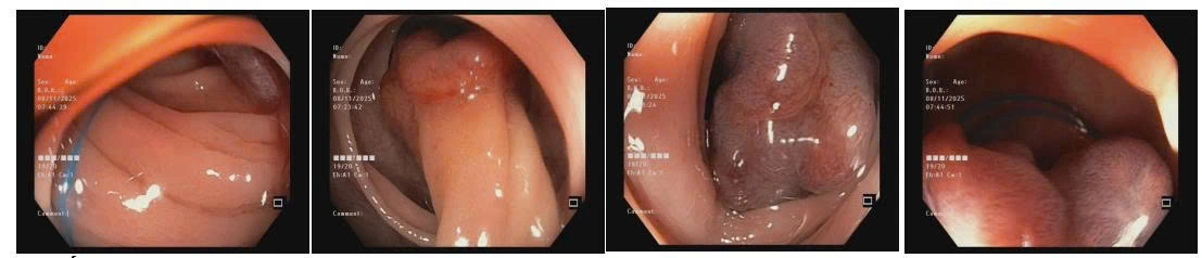 Trích từ hồ sơ lâm sàng thực tế tại Bệnh viện MEDIC Cà Mau