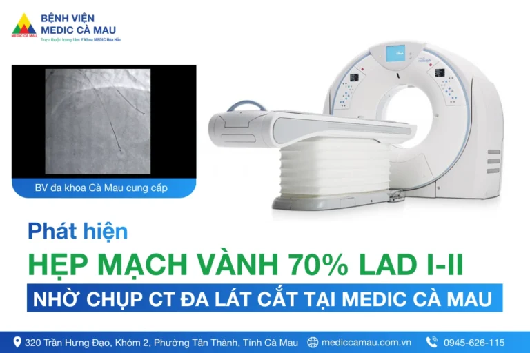 CẢNH GIÁC VỚI CƠN ĐAU NGỰC: KỊP THỜI CẤP CỨU BỆNH NHÂN NỮ 74 TUỔI BỊ HẸP ĐA NHÁNH MẠCH VÀNH
