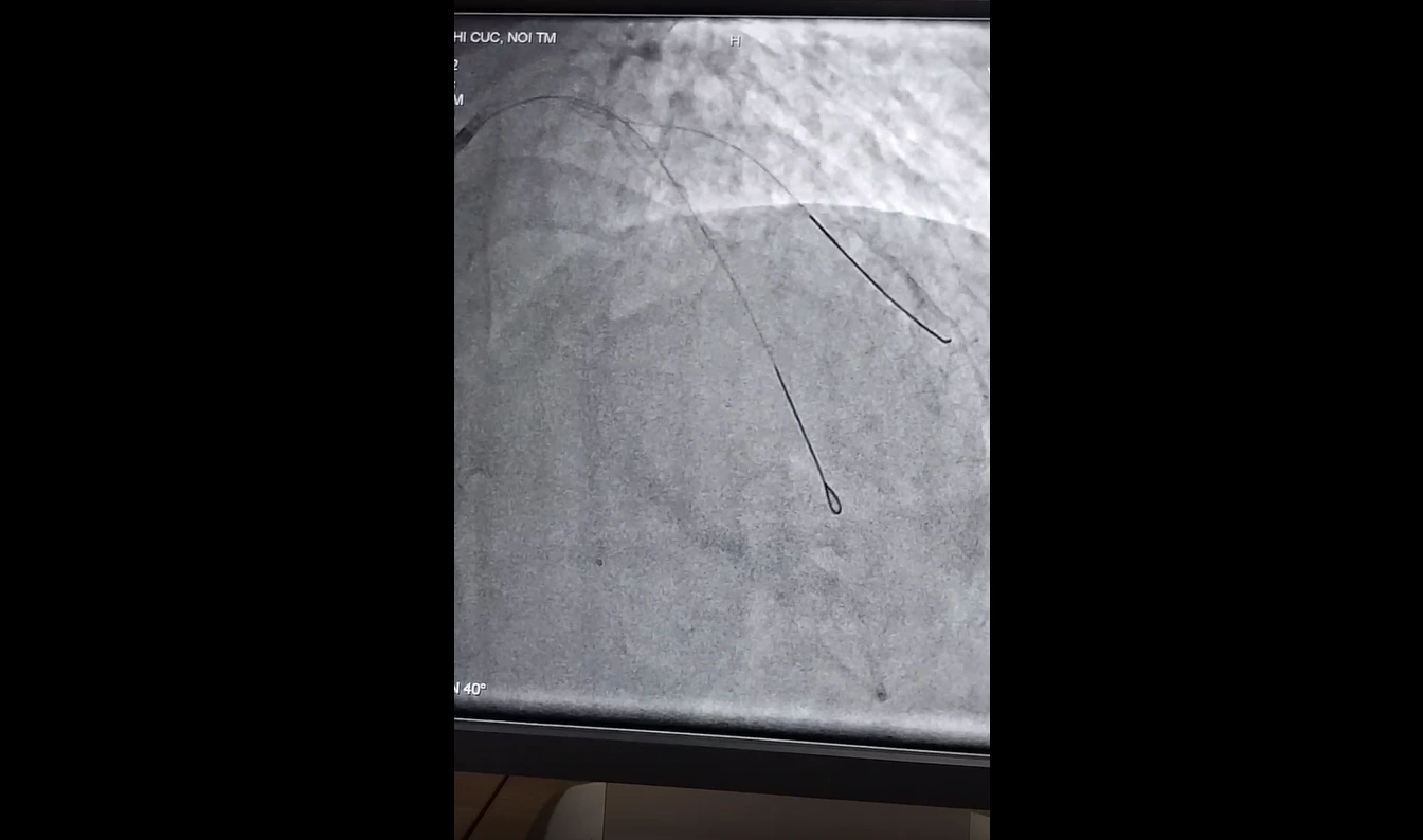 Bệnh nhân được can thiệp đặt stent mạch vành kịp thời tại Bệnh viện Đa khoa Cà Mau