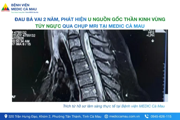 ĐAU BẢ VAI KÉO DÀI 2 NĂM, PHÁT HIỆN U NGUỒN GỐC THẦN KINH VÙNG TỦY NGỰC QUA CHỤP MRI TẠI MEDIC CÀ MAU