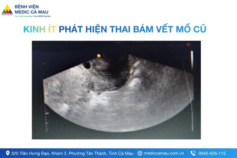 TỪ KINH ÍT PHÁT HIỆN THAI BÁM VẾT MỔ CŨ