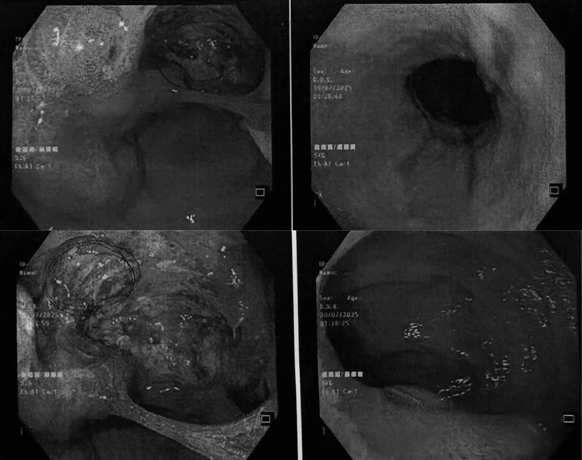 Trích từ hồ sơ lâm sàng thực tế tại Bệnh viện MEDIC Hòa Hảo Cà Mau